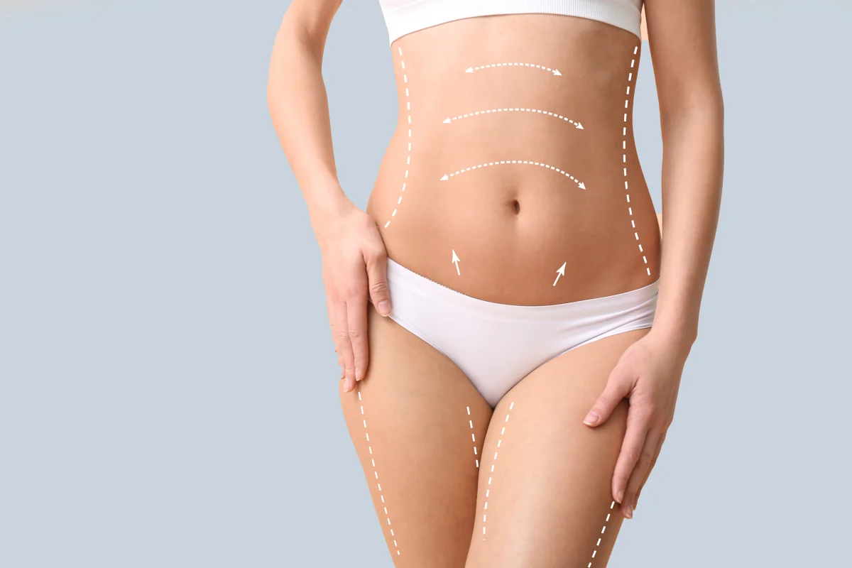 Fettabsaugung Facetite - Bodytite und Acutite