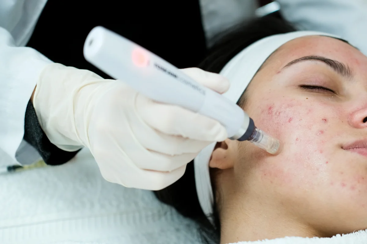 Medizinisches Microneedling mit Dermapen